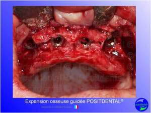 Mise en chage imm diate 160 fpizql - Eugenol