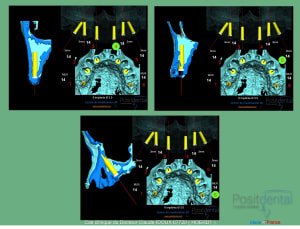 Mise en charge immédiade c - Eugenol