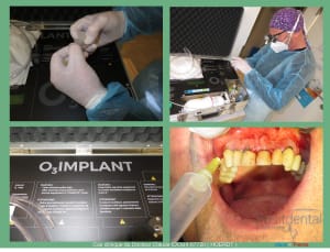 Mise en charge immédiade c - Eugenol