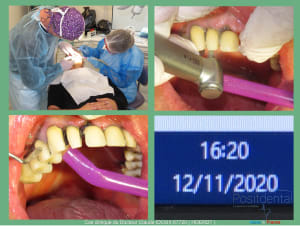 Mise en charge immédiade c - Eugenol