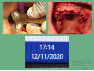 Mise en charge immédiade c - Eugenol
