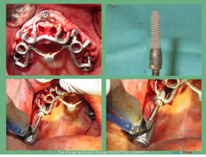 Mise en charge immédiade c - Eugenol