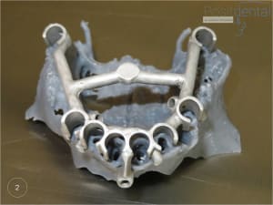 Mise en charge immédiate   chirurgie guidée 02 vv4pho - Eugenol