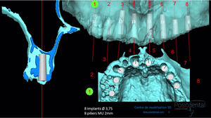 Mise en charge immédiate positdental012 - Eugenol