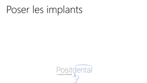 Mise en charge immédiate positdental022 j45cqc - Eugenol