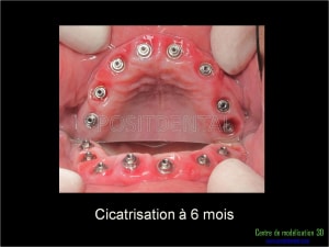 Mise en charge immédiate implant dentaire 020 r1iupi - Eugenol