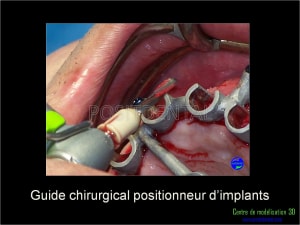 Mise en charge immédiate implant dentaire 040 clzzww - Eugenol