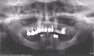 Mise en charge imm diate post extractinnelle mcipe omzx9k - Eugenol