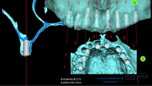 Mise en charge innédiate positdental 015 krtvb9 - Eugenol