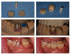 Montage implant 36  pilier zr c ram empress  riqied - Eugenol