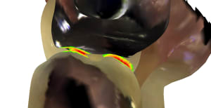 Occlusion 3 id85 e386ci - Eugenol