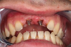Piliers lreb5h - Eugenol