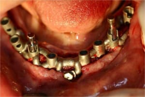 Positdental 1 f2uwop - Eugenol