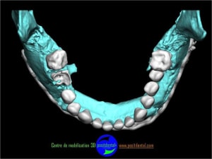 Positdental 6 fym8lf - Eugenol