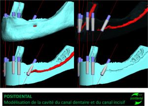Positdental mod lisation de la cavit du canal dentaire ctxzdq - Eugenol