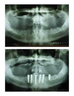Pano implants  custom  do5i1p - Eugenol