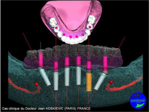 Planification implantaire assist e par ordinateur  guide radio opaque 1 f2ecyv - Eugenol