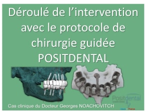 Pose d implants et d un bridge à armature métal en 1 seule intervention g - Eugenol