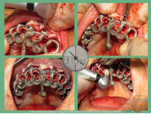 Pose d implants et d un bridge à armature métal en 1 seule intervention g - Eugenol