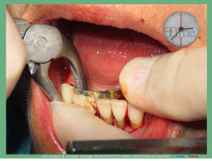 Pose d implants et d un bridge à armature métal en 1 seule intervention g - Eugenol