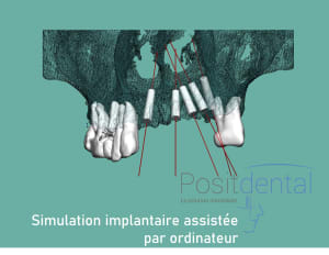 Positdental mise en charge immédiate 002 sgneo4 - Eugenol