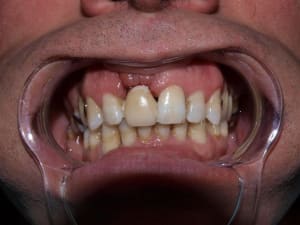Post op 1 semaine  1  tslajt - Eugenol