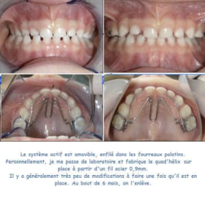 Quad1 abrynx - Eugenol