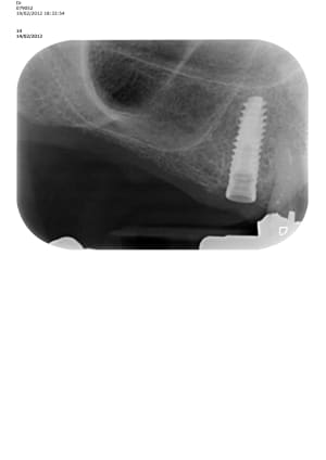 Radio implant nuxqed - Eugenol
