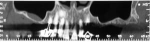 Radiographie n 1 nqn5lc - Eugenol