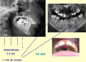 Radiotherapie qcsnjy - Eugenol