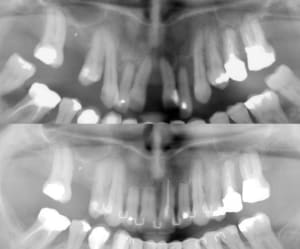 Resorption snm4rw - Eugenol