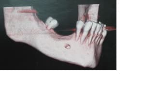 Scan 3d dkgcwb - Eugenol