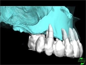 Simullation implantaire assist e par ordinateur positdental 006 vfsp8j - Eugenol
