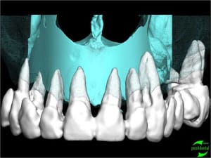 Simullation implantaire assist e par ordinateur positdental 009 m5ck9c - Eugenol