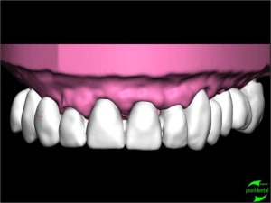 Simullation implantaire assist e par ordinateur positdental 013 q8xlbu - Eugenol