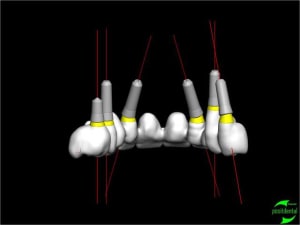 Simullation implantaire assist e par ordinateur positdental 018 vmrpza - Eugenol