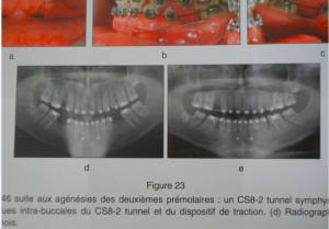 Vis symphysaires pessdf - Eugenol