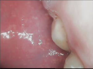 Abces uzmvge - Eugenol