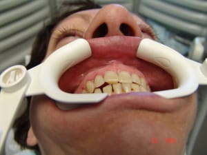 Acro2 xv4smv - Eugenol