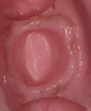 Alginate bpowvn - Eugenol