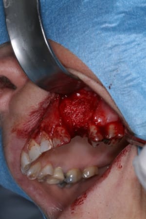 Alv ole combl e y1zrlg - Eugenol