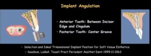 Angulation implant lbs03s - Eugenol
