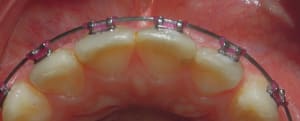 Anne onima post reconstitution thv5mq - Eugenol