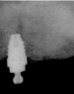Apres2 wax5hl - Eugenol