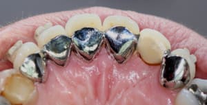 Attelle en bouche zbunoq - Eugenol