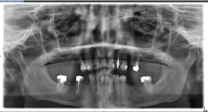 Avant opqvab - Eugenol