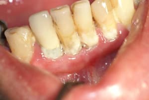 Blanchiment2 ekqkpf - Eugenol