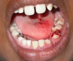 Bouche1 oygnwh - Eugenol
