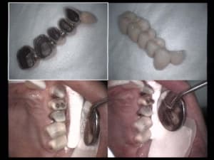 Bridge a ilzqsa - Eugenol