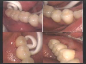 Bridge céramique sur zircone dense scellé sur implants 37  36 et 35 ii qouc9r - Eugenol